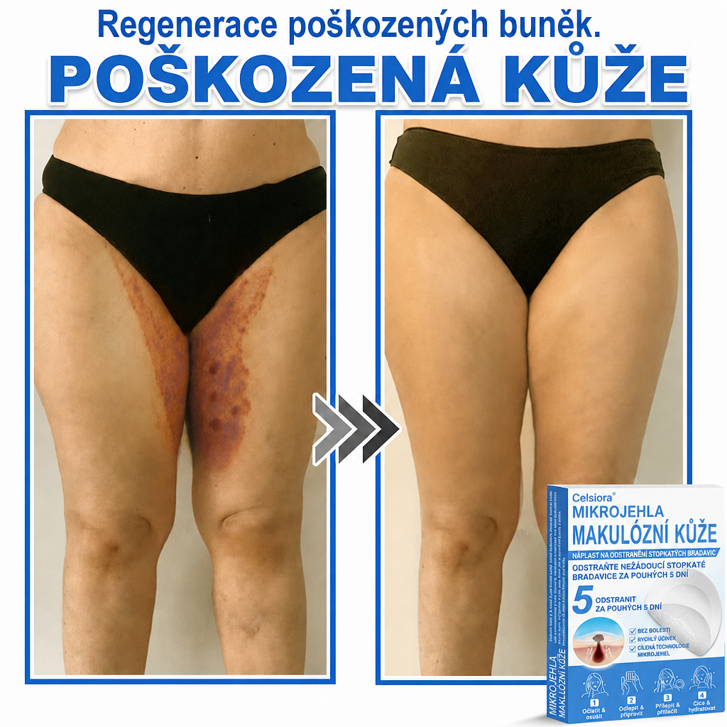 🏆Celsiora® Náplasti 2 v 1 s mikrojehličkami a hydrokoloidem | Odstraňovač vystouplých kožních výrůstků💢💢