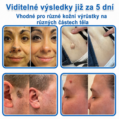 🏆Celsiora® Náplasti 2 v 1 s mikrojehličkami a hydrokoloidem | Odstraňovač vystouplých kožních výrůstků💢💢