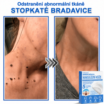 🏆Celsiora® Náplasti 2 v 1 s mikrojehličkami a hydrokoloidem | Odstraňovač vystouplých kožních výrůstků💢💢