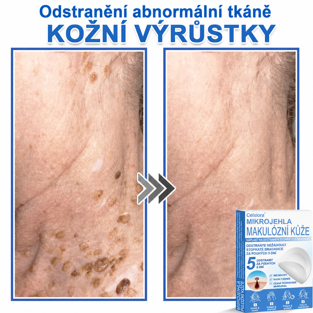 🏆Celsiora® Náplasti 2 v 1 s mikrojehličkami a hydrokoloidem | Odstraňovač vystouplých kožních výrůstků💢💢