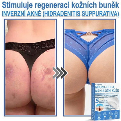 🏆Celsiora® Náplasti 2 v 1 s mikrojehličkami a hydrokoloidem | Odstraňovač vystouplých kožních výrůstků💢💢